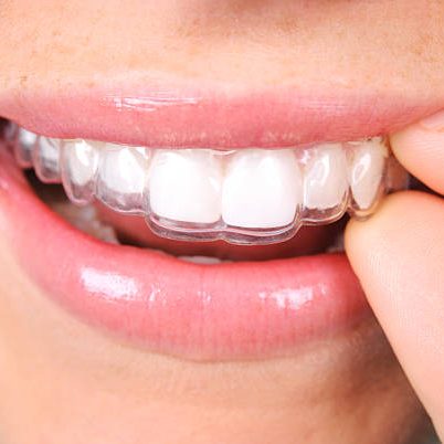 invisalign