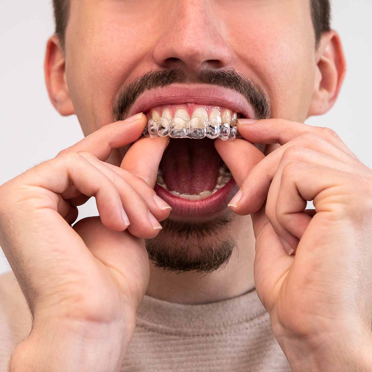 invisalign male model